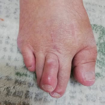 Selçuk Üniversitesi Tıp Fakültesi Hastanesi Ayak Ameliyatı Sonrası