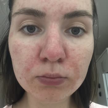 Fethiye Devlet Hastanesi Cildiye Bölümü İlaç Kullanımı Sorunu