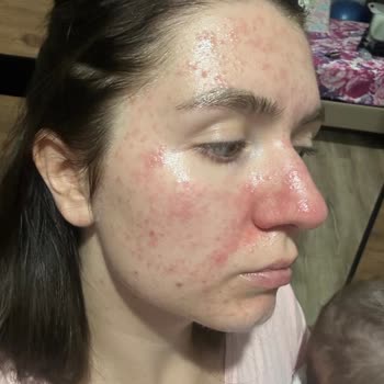 Fethiye Devlet Hastanesi Cildiye Bölümü İlaç Kullanımı Sorunu