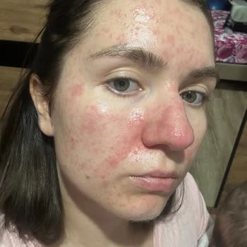 Fethiye Devlet Hastanesi Cildiye Bölümü İlaç Kullanımı Sorunu