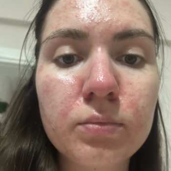 Fethiye Devlet Hastanesi Cildiye Bölümü İlaç Kullanımı Sorunu