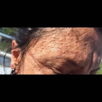Solante Güneş Kremi Alerji Yapması