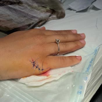 Kızılay Maden Suyu Cam Şişesi Patlaması