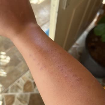 Medihest Clinic'te Lazer Tedavi (leke)