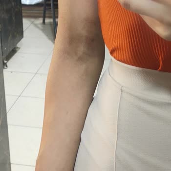 Manisa Merkezefendi Devlet Hastanesi Kan Verirken Kolum Şişti Ve Morardı