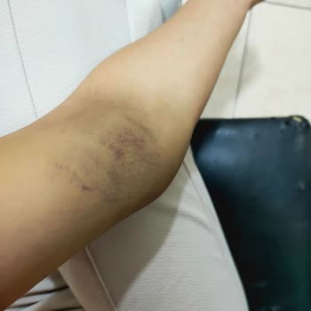 Manisa Merkezefendi Devlet Hastanesi Kan Verirken Kolum Şişti Ve Morardı