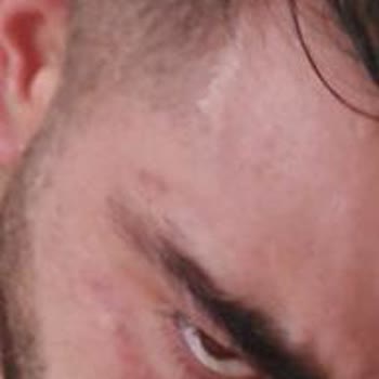 Ümraniye Renew Estetik'te Lazer Epilasyon Seansında Yüzümü Yaktılar