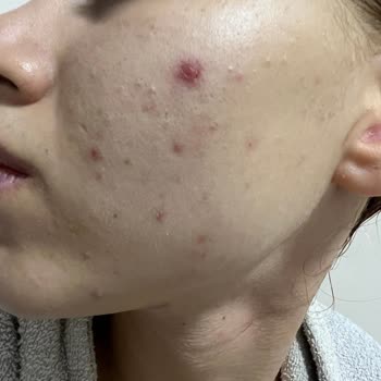 The Purest Solutions Güneş Kremi Yüzümü Mahvetti