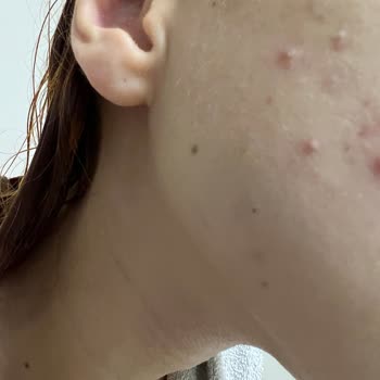 The Purest Solutions Güneş Kremi Yüzümü Mahvetti