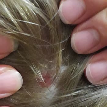 Palette Yüzünden Kafa Derim Yandı