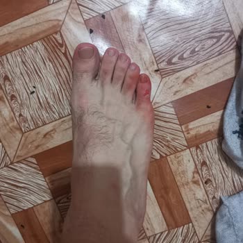 Yeni Aldığım Adidas Halısaha Ayakkabılarım Her Maçta Ayağımı Kanatıyor