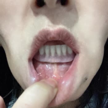 Tebessüm Diş Hastaneleri Yapılan Dişler Günler İçerisinde Paramparça Oldu