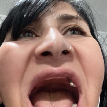 Tebessüm Diş Hastaneleri Yapılan Dişler Günler İçerisinde Paramparça Oldu