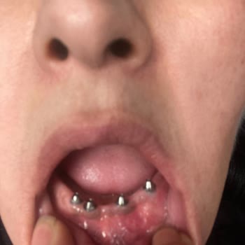 Tebessüm Diş Hastaneleri Yapılan Dişler Günler İçerisinde Paramparça Oldu