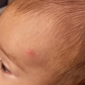 Kiperin Collagen Kiperin Kolajen Sivilce Sorunu