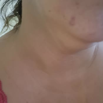 Kiperin Collagen Kiperin Kolajen Sivilce Sorunu