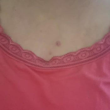 Kiperin Collagen Kiperin Kolajen Sivilce Sorunu