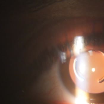 Osmangazi Göz Şikayet