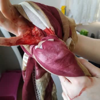 Motek Temizlik Setinin Sapı Elimi Parçaladı