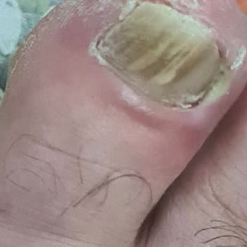 Ümraniye Eğitim Ve Araştırma Hastanesi'ndeki Tırnak Çekme Sorunu