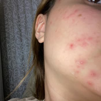 La Roche - Posay Yüzümde Sivilce Problemi