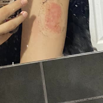 Dexcom G6 Kaşıntı Alerji