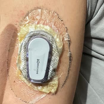 Dexcom G6 Kaşıntı Alerji