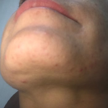 Kayrafermente.com Fermente Ürün Sivilce Ve Leke Oluşturuyor