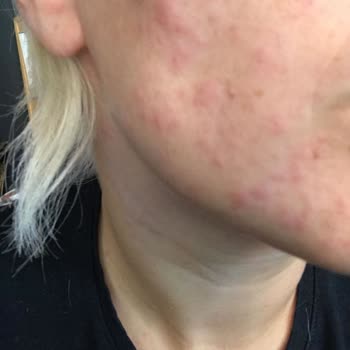 Avene Krem Alerji Yaptı