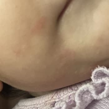 Sma Optipro Alerji Yaptı