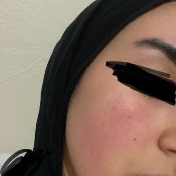 Hepsiburada Loreal Paris Güneş Kremi Yüzümü Mahvetti.