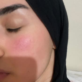 Hepsiburada Loreal Paris Güneş Kremi Yüzümü Mahvetti.