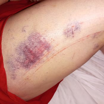 Terrace Hotel İnkum İhmalkarlıkları Yüzünden Ne Hale Geldim