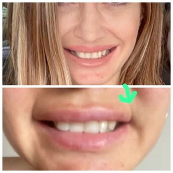 Dr. Selçuk Köroğlu Massater Botoks Şikayetim