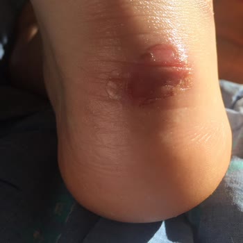 In Street'ten Nike Kalıbı Dar Ayakkabı Ayağın Topuk Kısmını Parçaladı