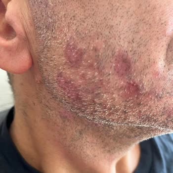 Trendyol Softto Plus Şampuan Yüzünden Ciltteki Yaralar.