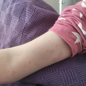Berko İlaç İbramın Zero Alerji Yapıyor