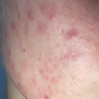 Simple Skin Care Yüz Temizleme Jeli Tahriş Yaptı