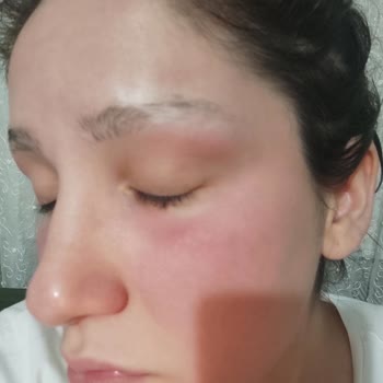 Bioderma Yüzüm Yandı Ve Şişti