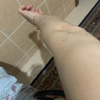 Sağlık Bakanlığı Uyuz Hastalığından Dolayı Devlet Yönetiminden Şikayetçiyim