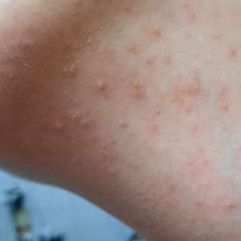 Neutrogena Cildime Zarar Verdi.