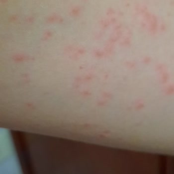 Neutrogena Cildime Zarar Verdi.