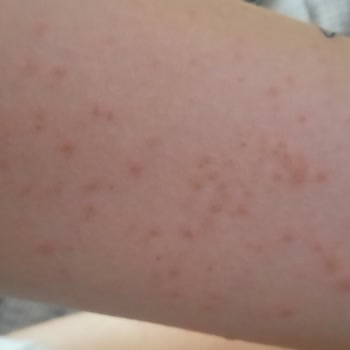 Neutrogena Cildime Zarar Verdi.