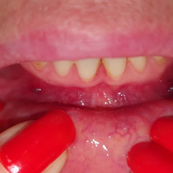 Dr. Turanşah Tümer Dis Eti Yerine Dis Sinirlerine Yapılan Suluk