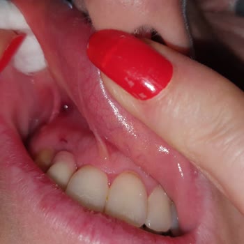 Dr. Turanşah Tümer Dis Eti Yerine Dis Sinirlerine Yapılan Suluk