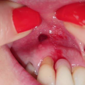 Dr. Turanşah Tümer Dis Eti Yerine Dis Sinirlerine Yapılan Suluk