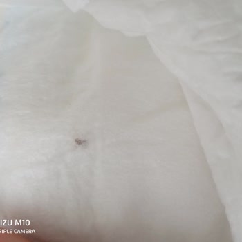 Molfix Bebek Bezindeki Siyahlık