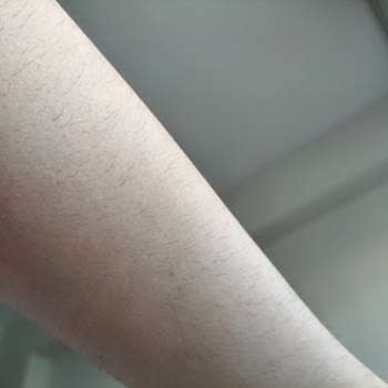 Dejavu Center Eskişehir Eskişehir Dejavu Güzellik Merkezi Lazerin Bir İşe Yaramaması