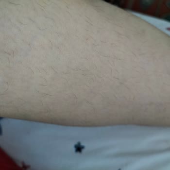 Dejavu Center Eskişehir Eskişehir Dejavu Güzellik Merkezi Lazerin Bir İşe Yaramaması