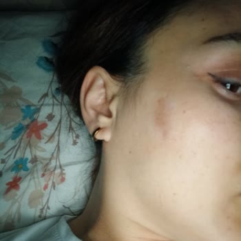 Haleplioğlu Güzellik Merkezi Yüzümü Yaktılar İzi Kaldı